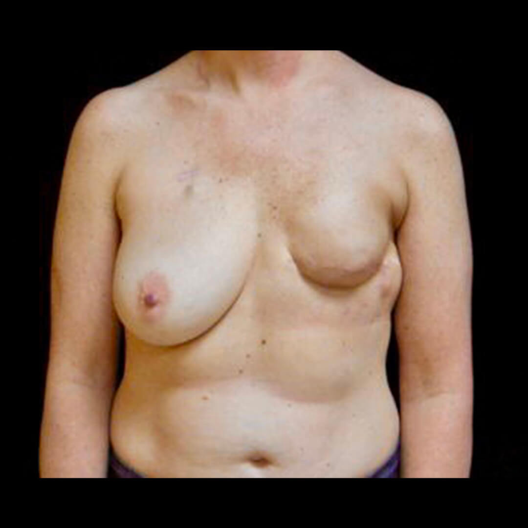 Breast-Reconstruction-1-Front-Before